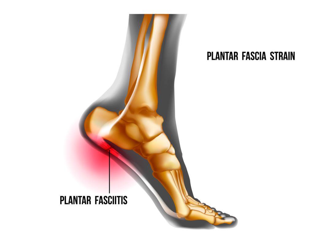plantar fasciitis specialist